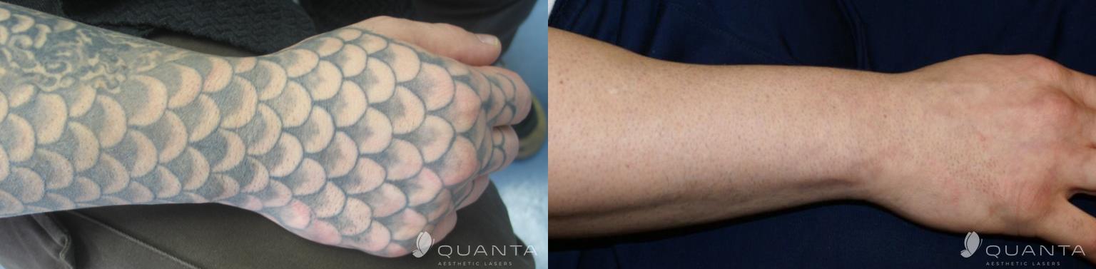 permanent tattoo removal clinic in bangalore 1000 geometric permanent tattoo removal clinic in bangalore 1000 geometric