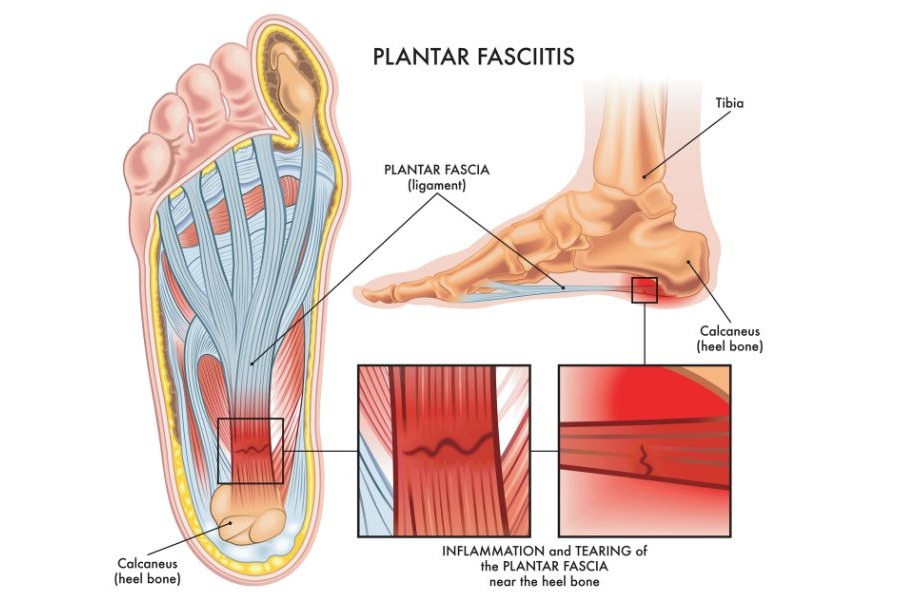 footplantar fasciitis inflamma