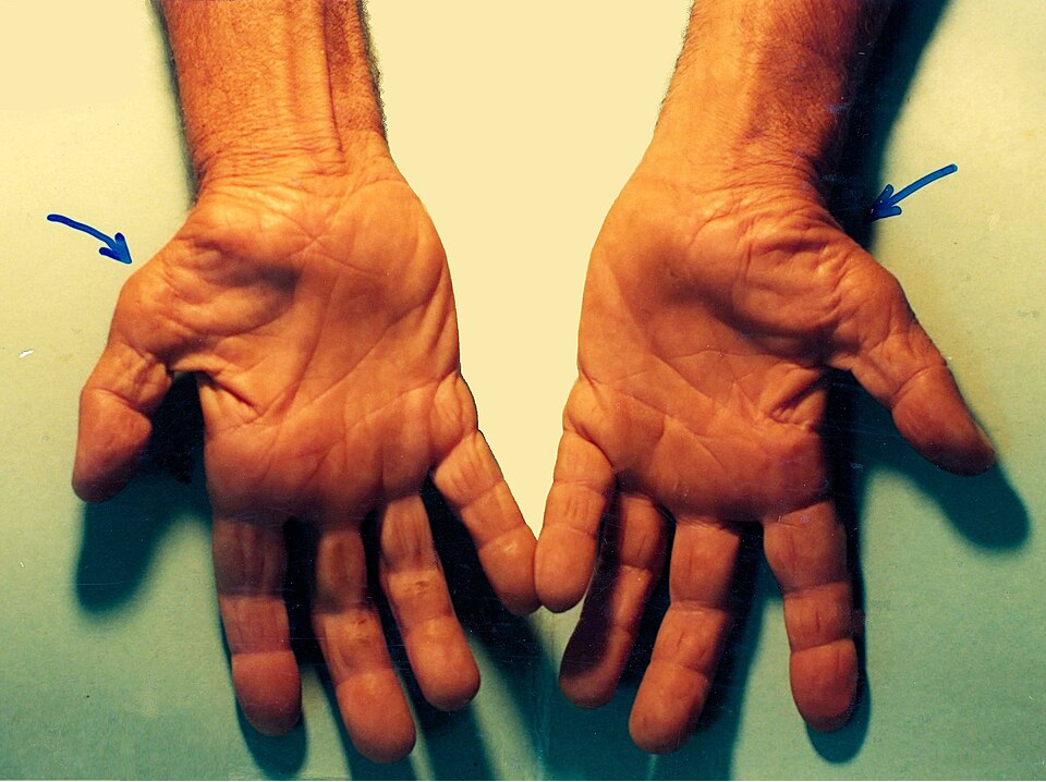 wrist injury