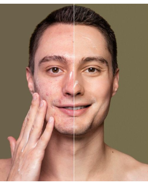 laser scar removal