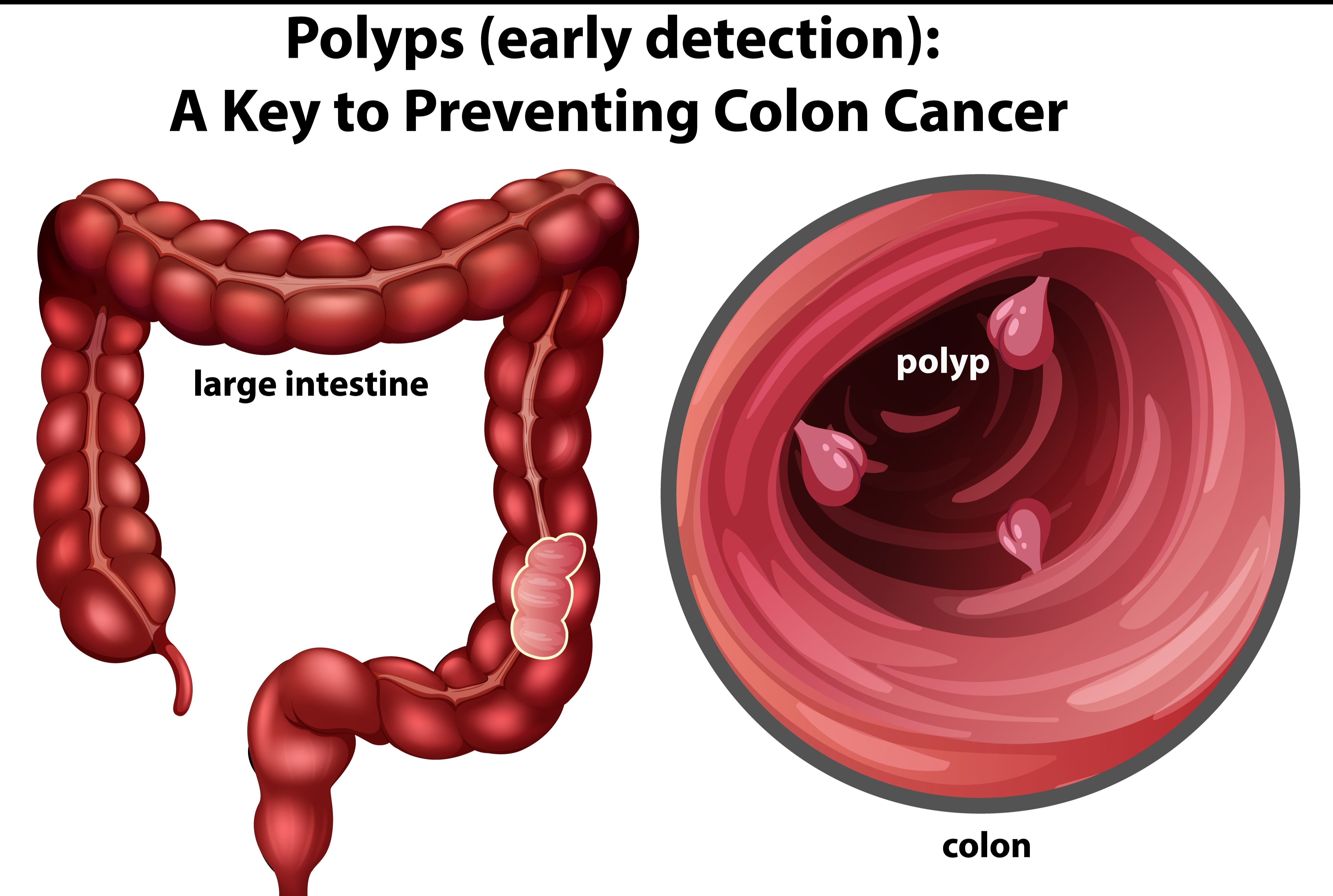 Best Colon Cancer Treatment in Pimple Saudagar – Evidence-Based ...