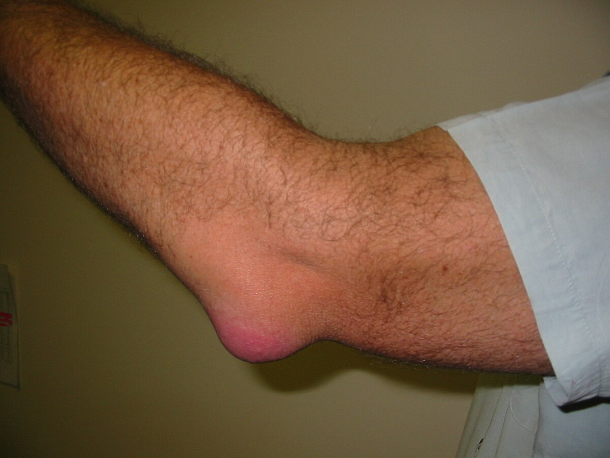 called nursemaids elbow