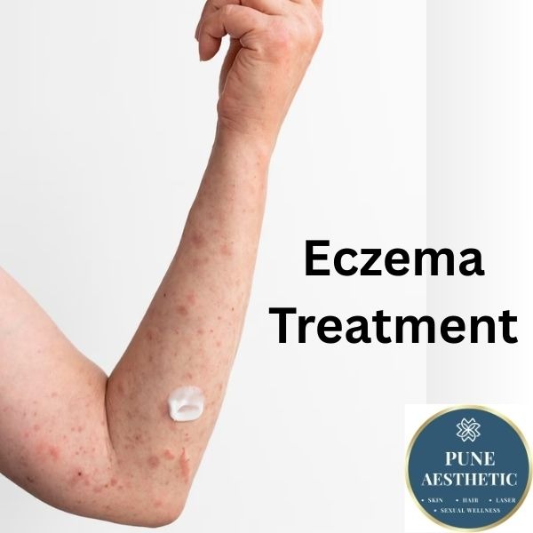 eczema