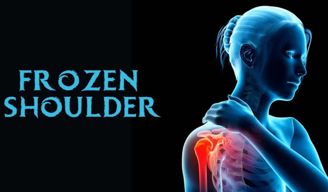 adhesive capsulitis