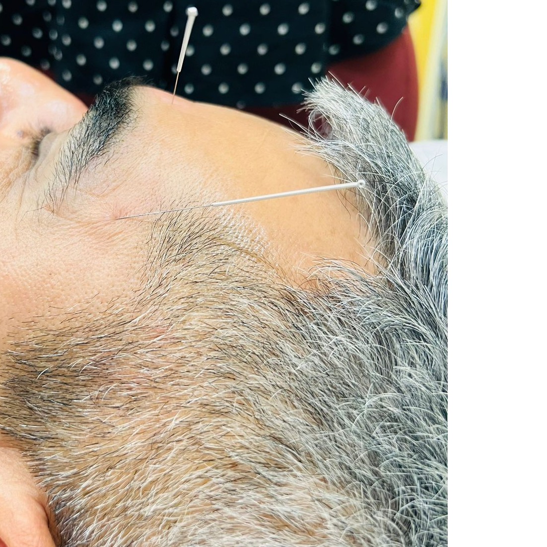 tension headaches