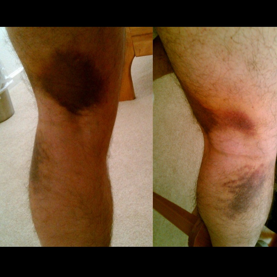 discrelated injuries effective