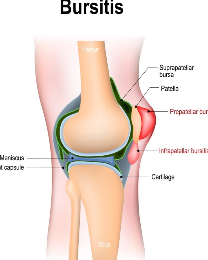 fluidfilled sac