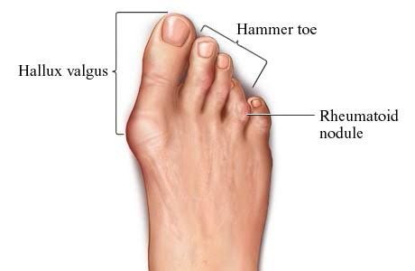 Rheumatoid Arthritie