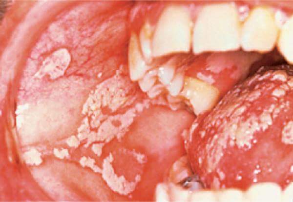ORAL CANDIDIASIS VERY COMMON INFECTION IN HIV main image