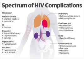hiv complications which occur in the absence of hi... main image