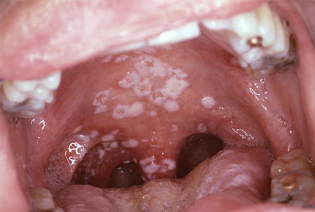 oral ulcers most commonly due  to fungal infect... main image
