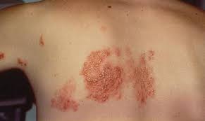 herpes zoster infection very common in hiv main image