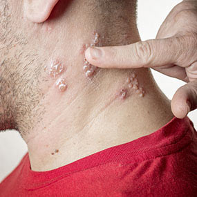 hherpes  zoster  is common in hiv infected . main image