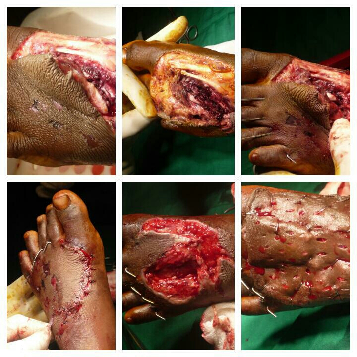 Trauma Foot - Multip