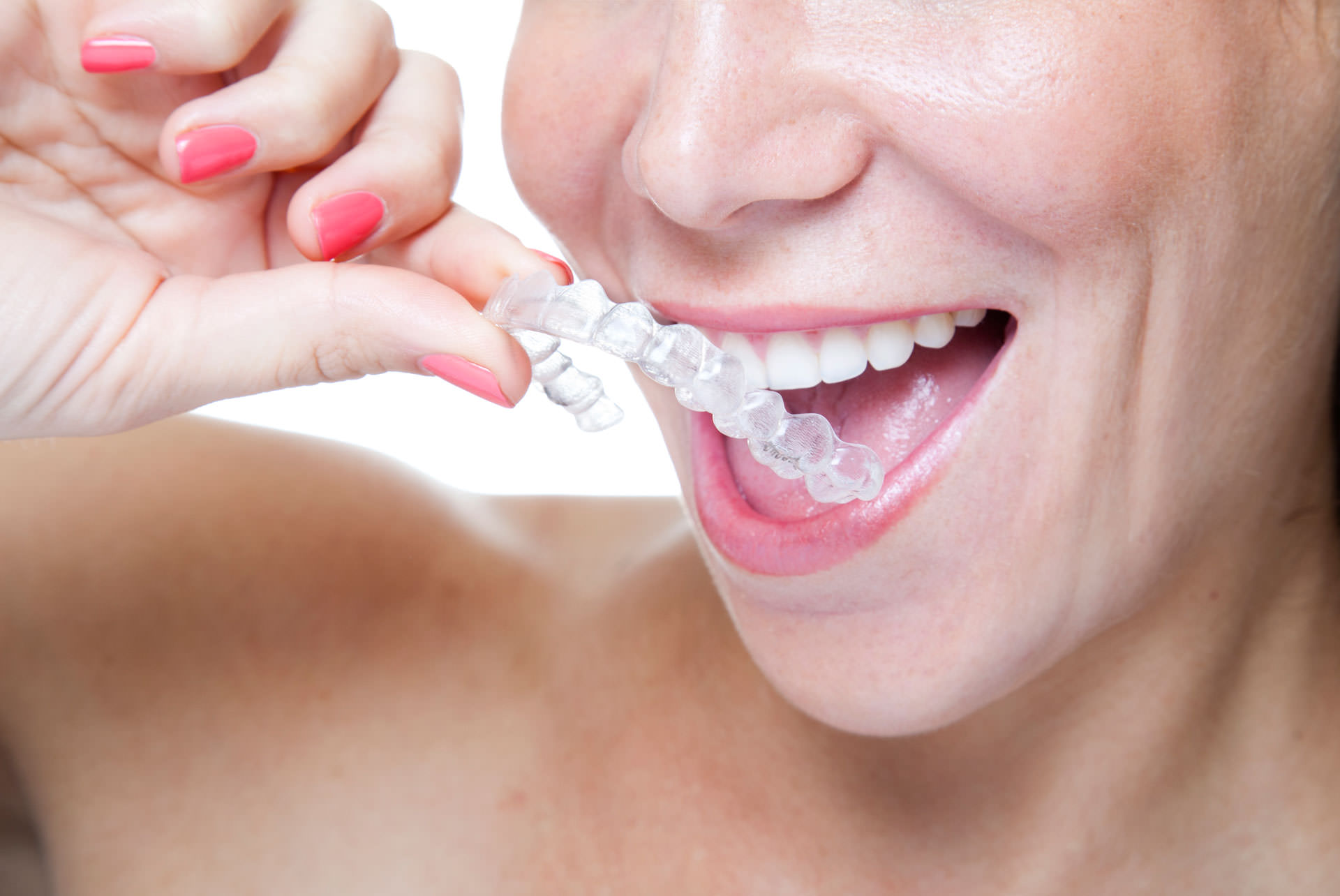 Aligners as thin as
