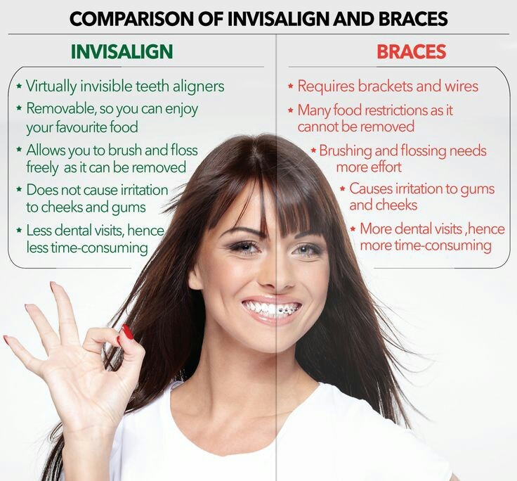 Invisalign, the alte