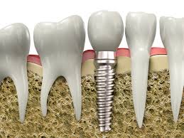 DENTAL IMPLANTSA de