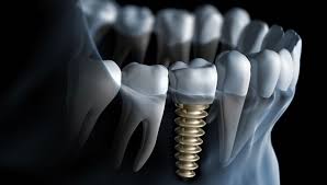 Dental implants are