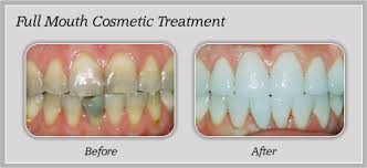 Cosmetic dental fill
