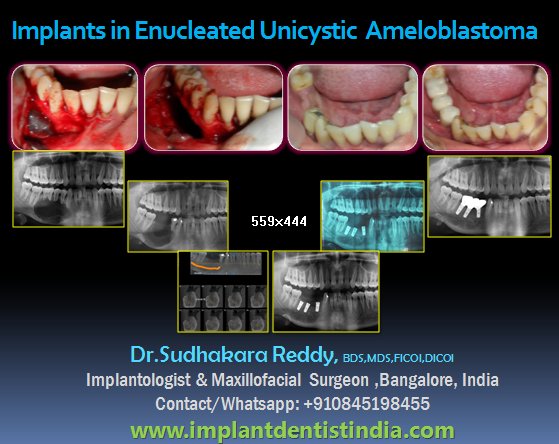 DentalImplantsindia in Bangalore; Dr. Sudhakara Reddy is a ...