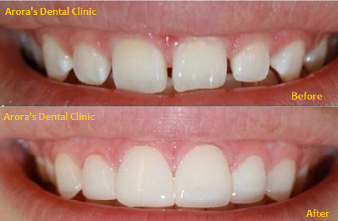 Smile improvement