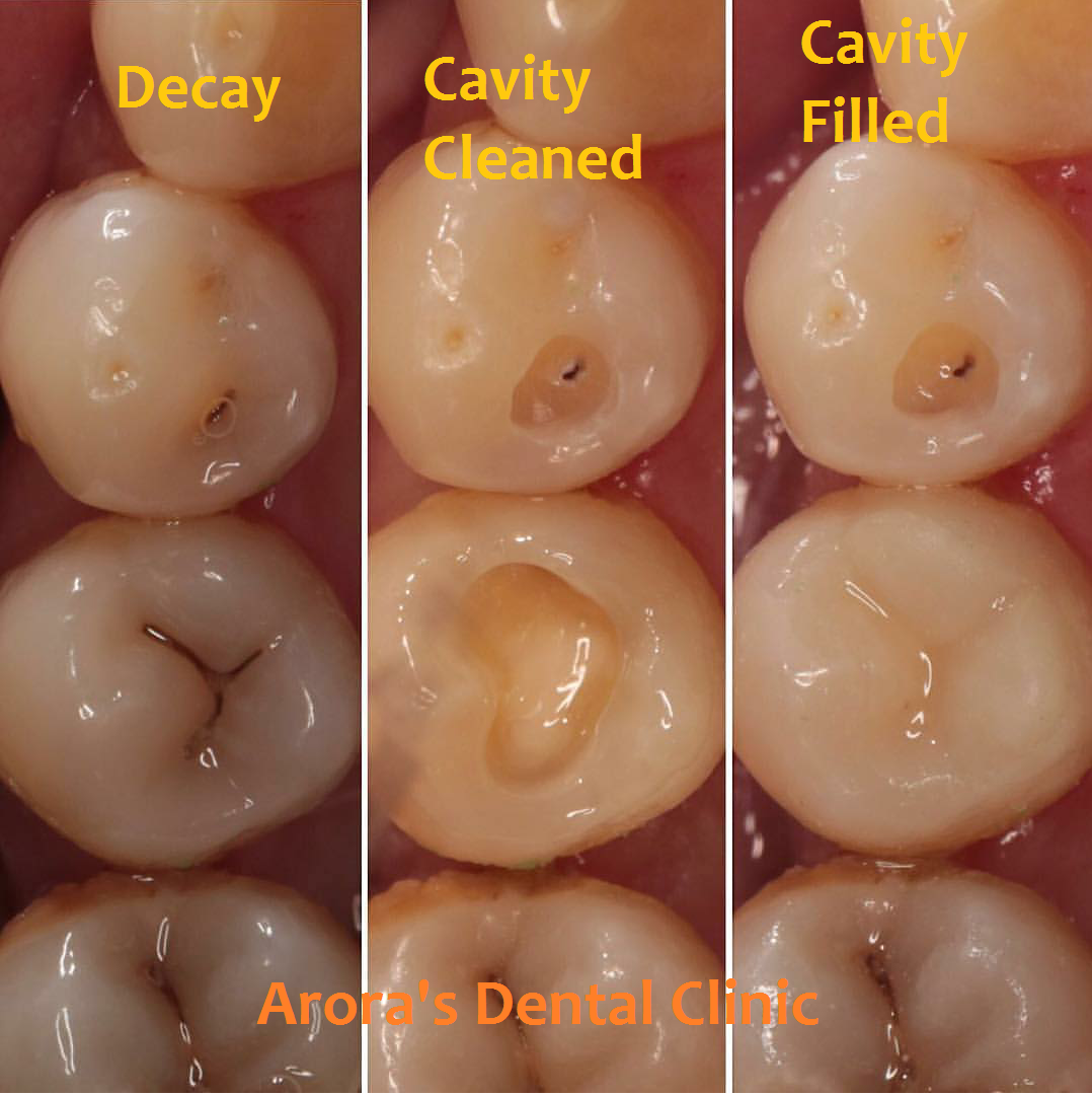 Cavity : Decayed p