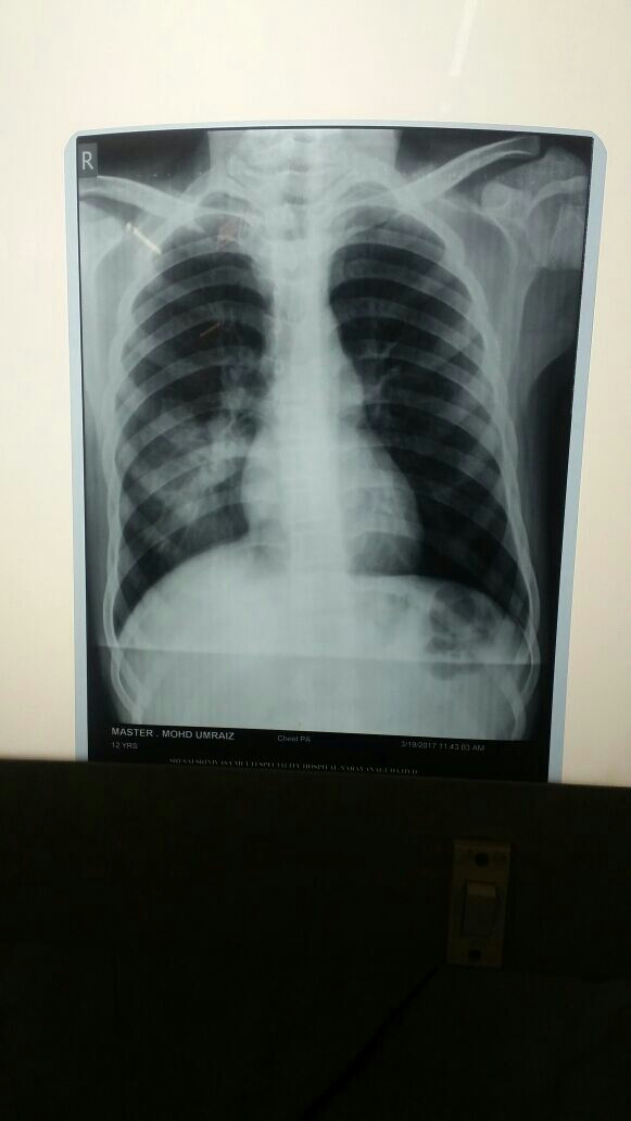 community acquired pneumonia common common in hiv main image