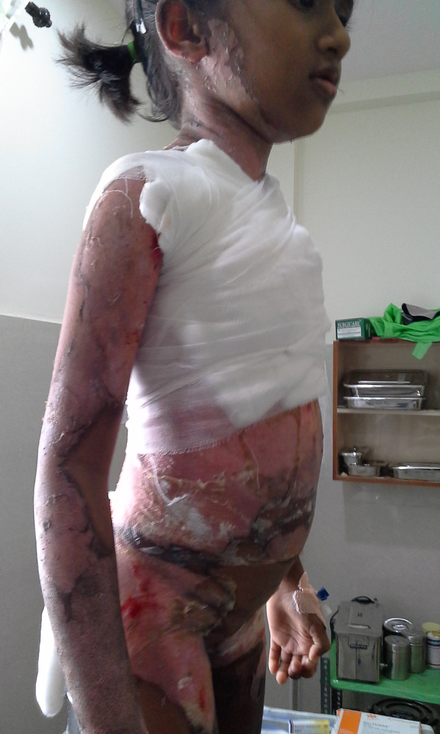 70 % BURNS  IN A 7 YRS OLD CHILD TREATED SUCCES... main image