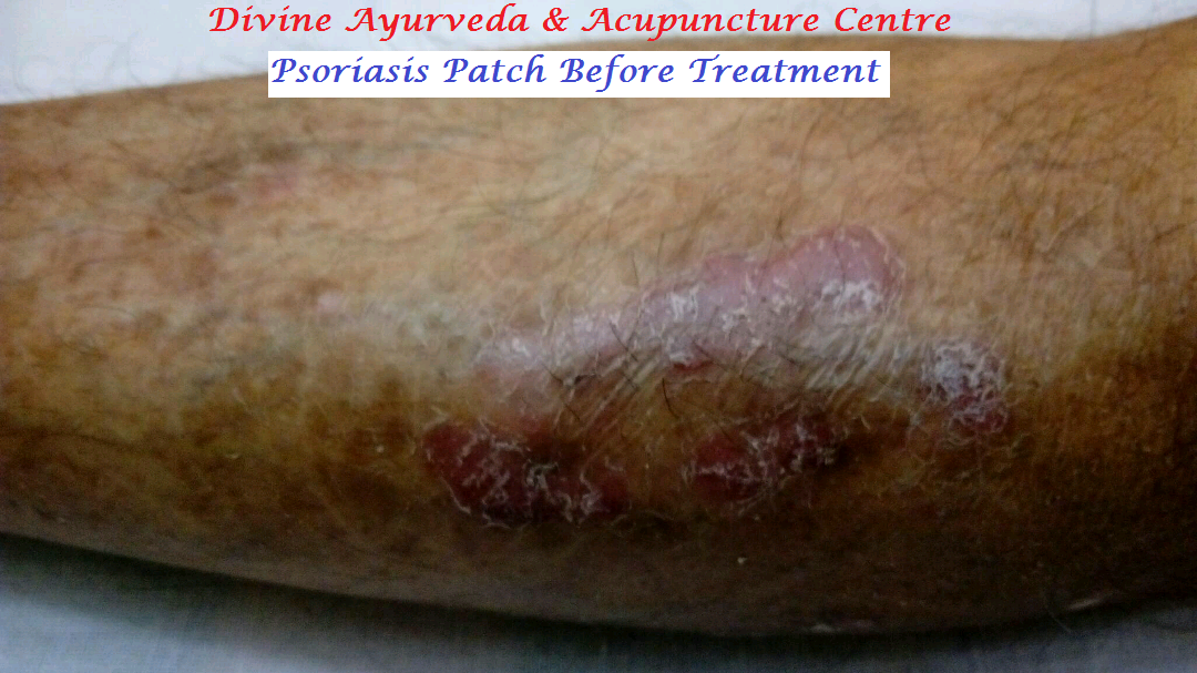 MANAGING PSORIASIS W