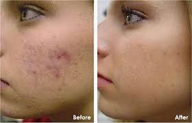 Peeling is the appli