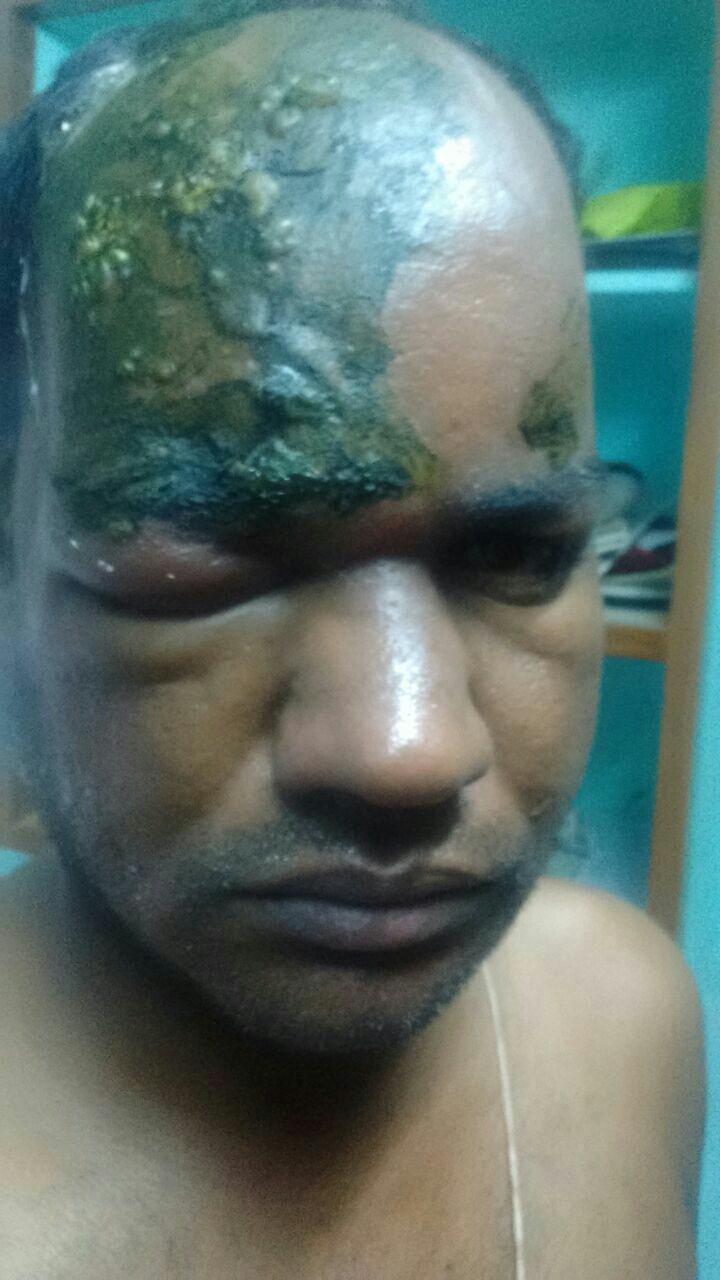 Herpes zoster infection common in hiv infected ... main image