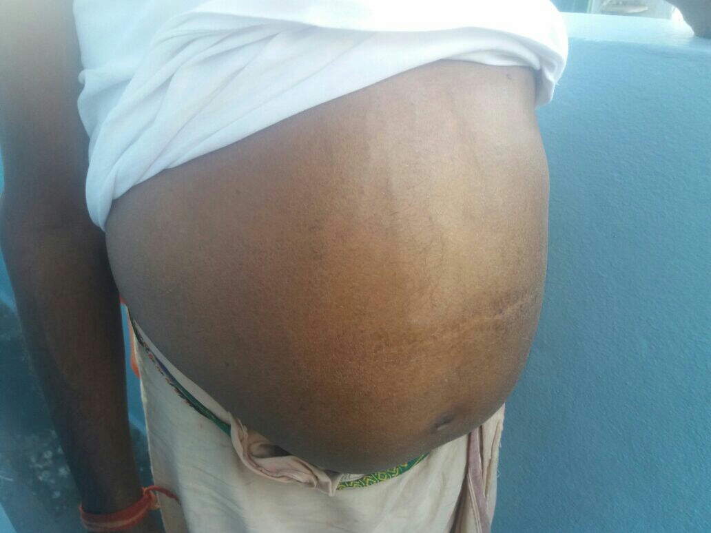 Abdominal swelling (ascitis) due to tuberculosi... main image