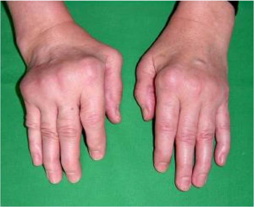 MANAGING RHEUMATOID
