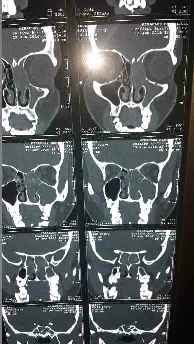 Sinusitis needs endo