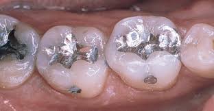 Braces Filling Sector 17 Faridabad main image