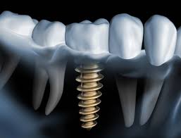 Dental Implant in Faridabad main image