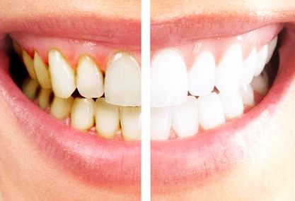 This wedding season, brighten your smiles by av... main image