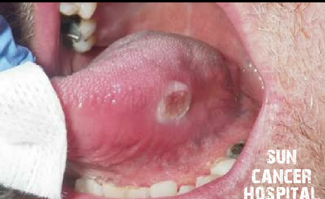 Tongue ca
