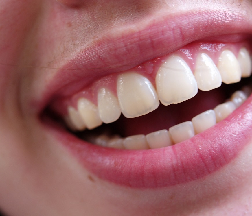 Bleeding gums is the first sign of gum disease.... main image