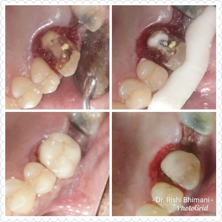 Sometimes, badly broken/fractured teeth can be ... main image