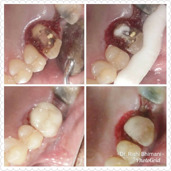 Badly broken and fractured teeth can be salvage... main image