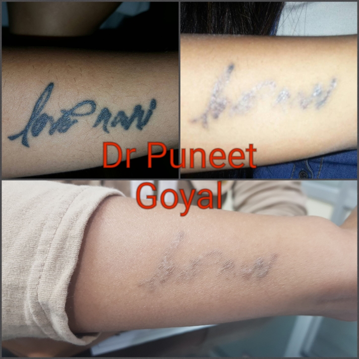tattoo removal by q switch nd yag laser 4 session excellent tattoo removal by q switch nd yag laser 4 session excellent