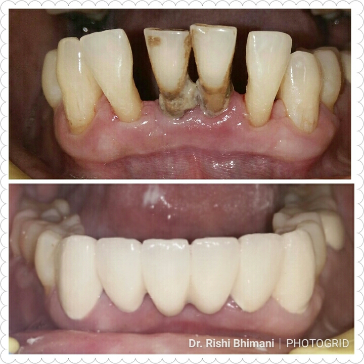 Gum disease causes bone loss and loosening of t... main image