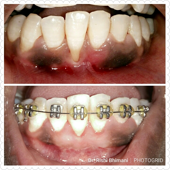 Receeding gums can be treated by gum grafting. ... main image