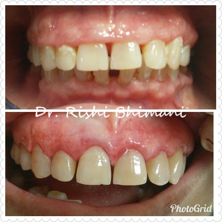 Smile designing and Gummy smile correction for ... main image
