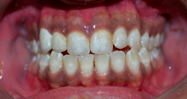 All Ceramic Crowns, 3 M Crowns, Orion Crowns, Z... main image