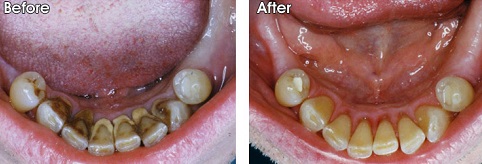 Professional Teeth cleaning & polishing (scalin... main image