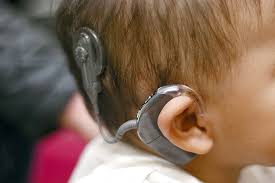 cochlear implant in