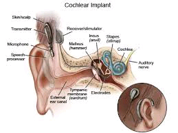 cochlear implant in