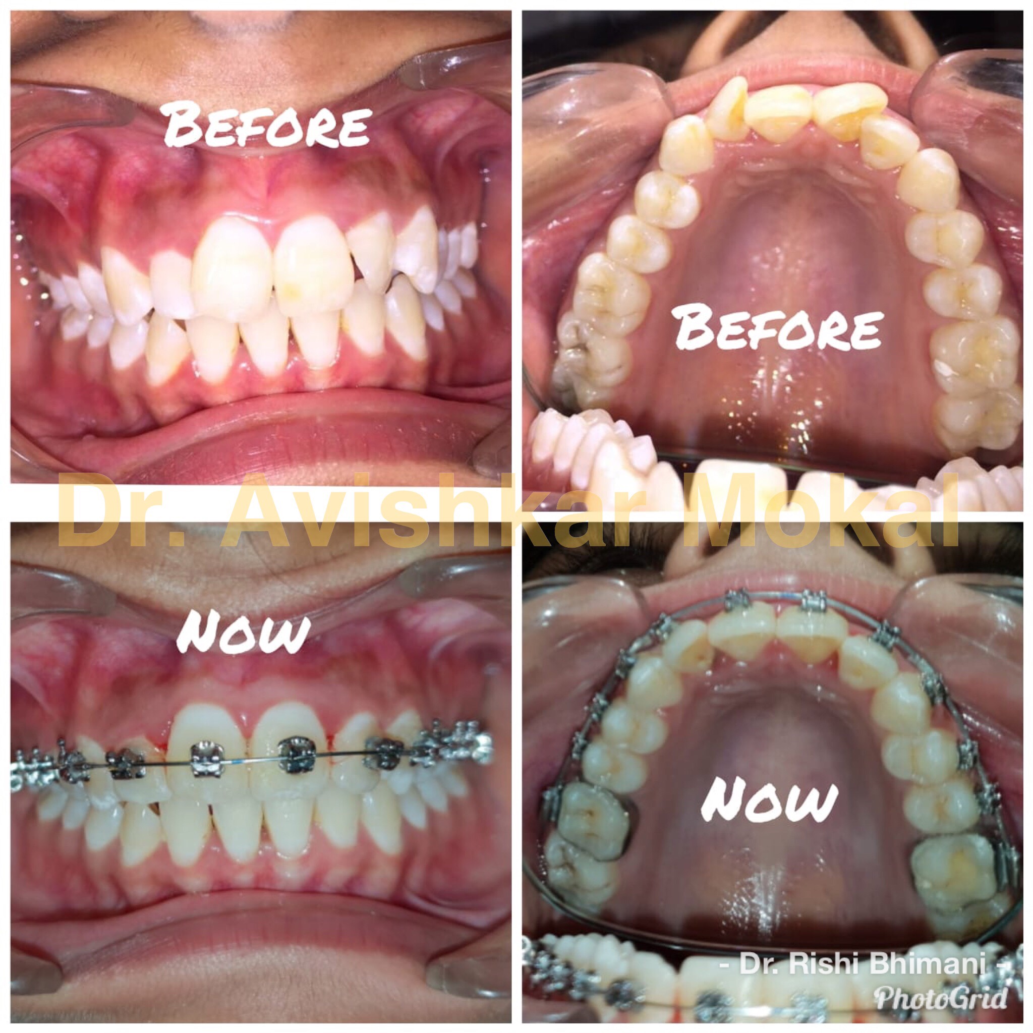 Treatment of irregular teeth, crowded teeth at ... main image